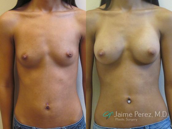Breast Augmentation: Saline Augmentation, Underarm Scar