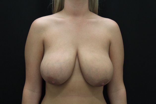 Breast Reduction Case 16 - Before
