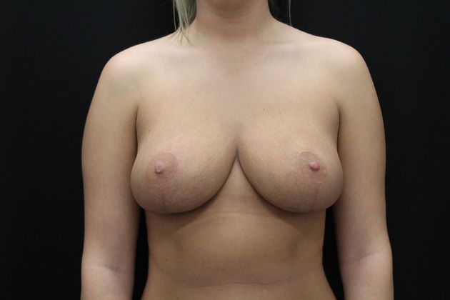 Breast Reduction Case 16 - After