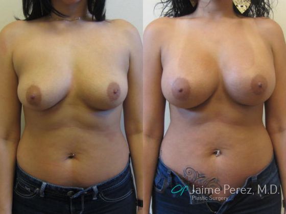 Breast Augmentation: Tampa 450cc Saline Breast Augmentation