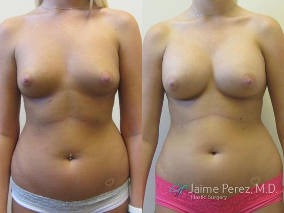 Breast Augmentation: Saline Breast Augmentation