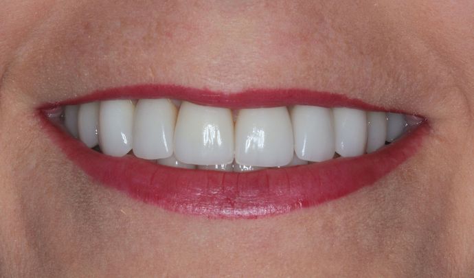 Porcelain Veneers: Case 24 - after
