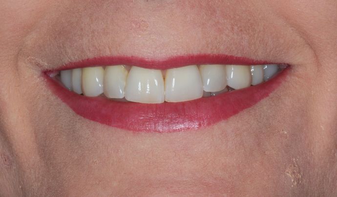 Porcelain Veneers Case 24 - Before