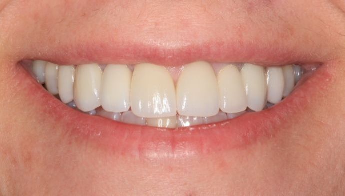 Porcelain Veneers Case 25 - After