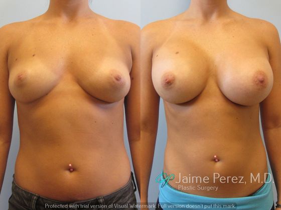 Breast Augmentation: Saline Breast Augmentation - 425cc