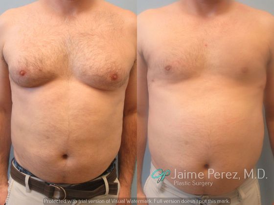 40 year old Gynecomastia - Male Breast Reduction/Gynecomastia - Before and  After Gallery