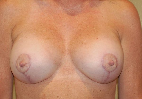 Breast Augmentation w/ Lift: Case 206 - After