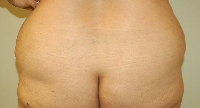Buttock Lift Case 6 - Before