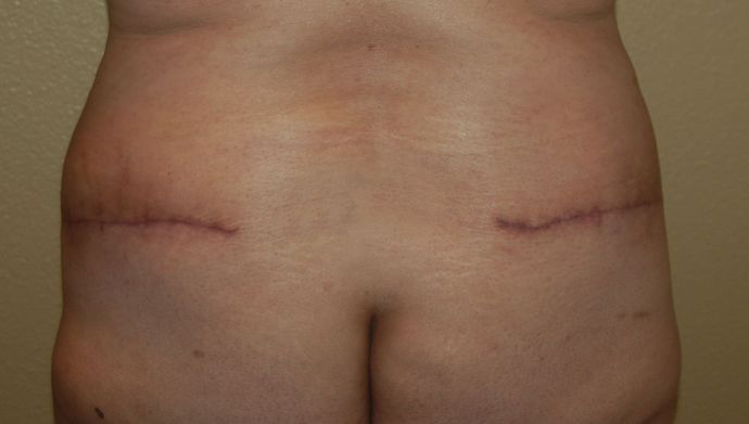 Buttock Lift Case 6 - After