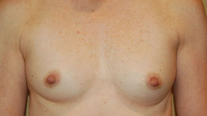 Breast Reconstruction Case 60 - Before
