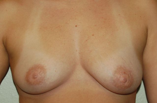 Breast Augmentation Case 440 - Before