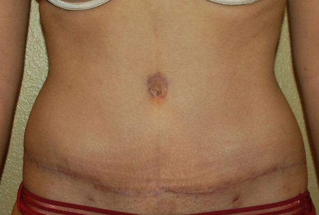 Tummy Tuck (Abdominoplasty) Case 126 - After
