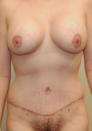 Mommy Makeover Case 90 - After