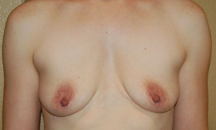 Breast Augmentation w/ Lift: Case 218 - Before