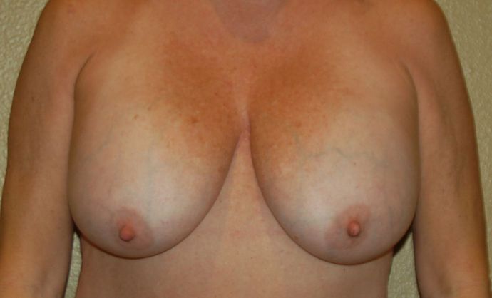 Breast Revision: Case 80 - Before