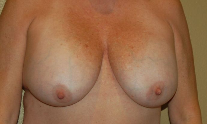 Breast Revision: Case 80 - Before