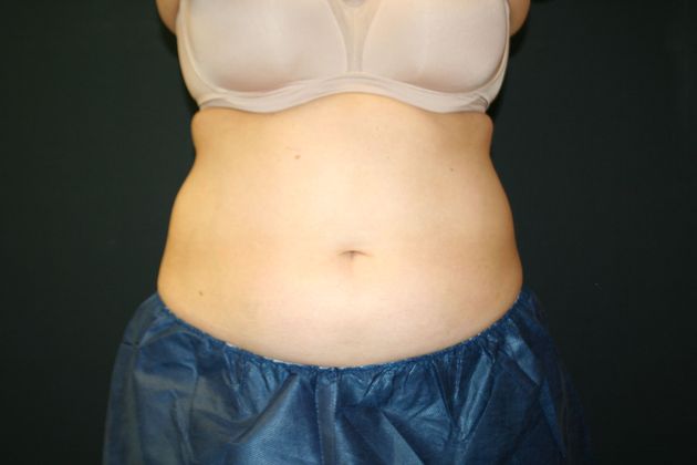 CoolSculpting®: Case 1 - BEFORE 