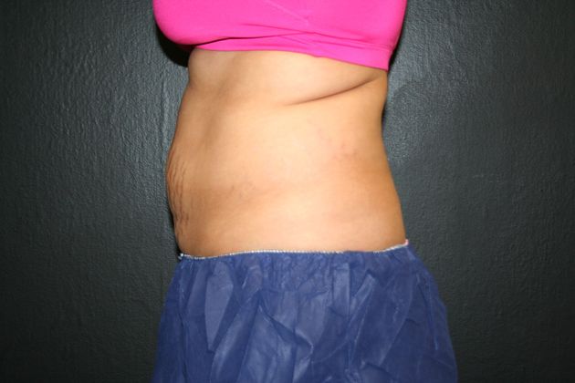 CoolSculpting®: Case 2 - BEFORE