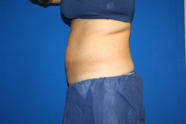 CoolSculpting®: Case 2 - AFTER (1 SESSION/4 APPLICATORS)