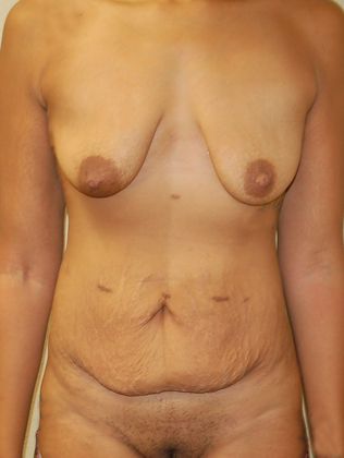 Mommy Makeover Case 94 - Before