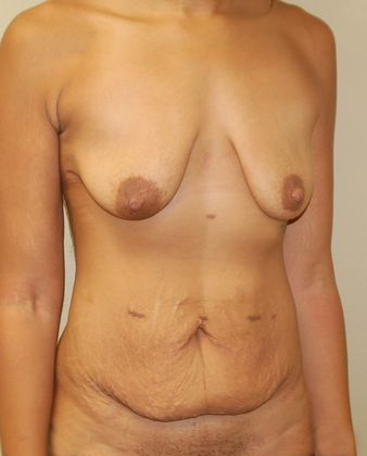 Mommy Makeover: Case 94 - Before