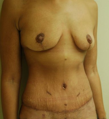 Mommy Makeover: Case 94 - After