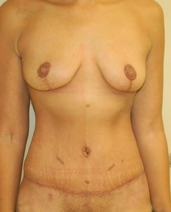 Massive Weight Loss  Case 43 - After