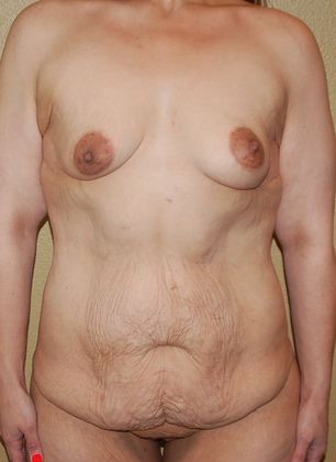 Massive Weight Loss : Case 44 - Before
