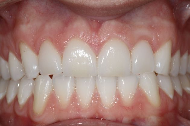 Porcelain Veneers:  Bill - AFTER