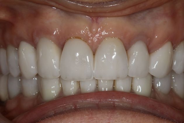 Full Mouth Rehabilitation: Sharon - After