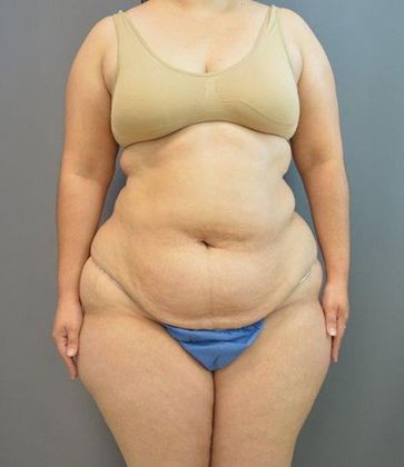 Liposuction Case 1 - Before