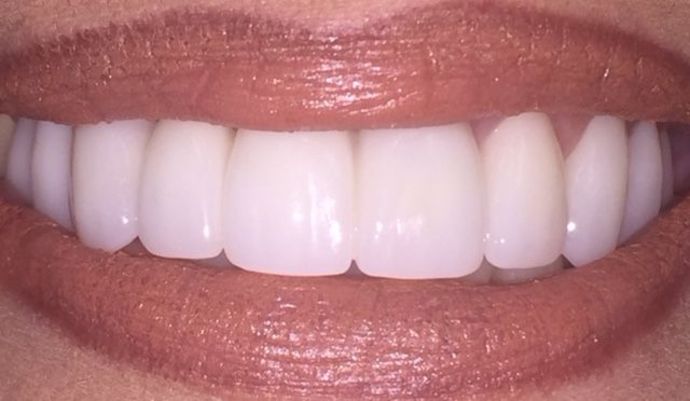 Porcelain Bridges Case 4 - After