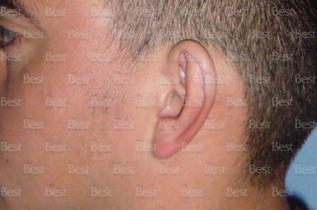 Otoplasty Otoplasty - Before