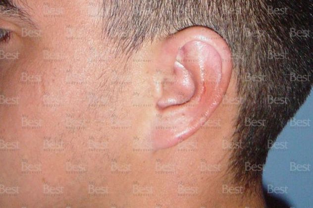Otoplasty Otoplasty - After