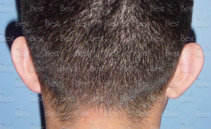 Otoplasty: Otoplasty - Before Otoplasty Posterior view