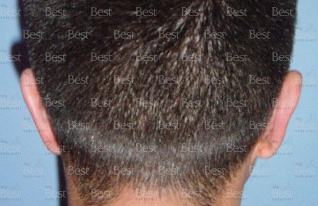 Otoplasty: Otoplasty - After Otoplasty posterior view