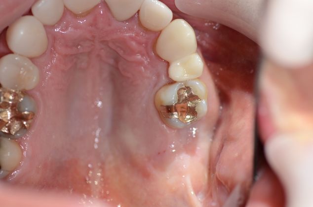 Dental Implants Case 18 - Before