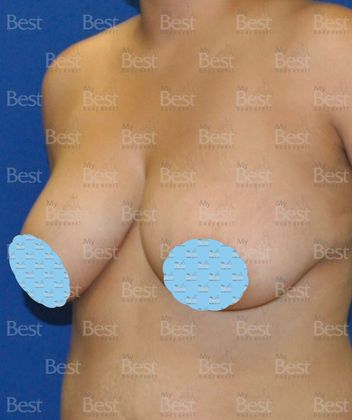 Before Breast Lift oblique view
