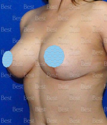 After Breast Lift oblique view