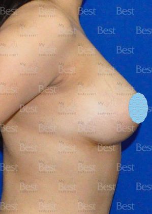 After Breast Lift Lateral view