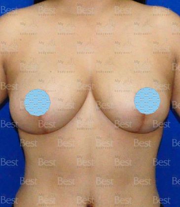 After Breast Lift Frontal view