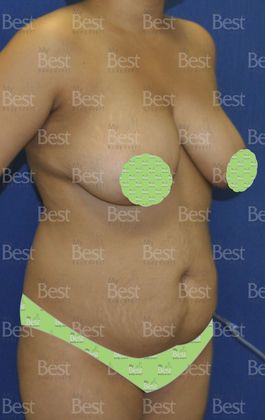 Mommy Makeover -Abdomen, Breast, Lipo, BBL-: Tummy Tuck, Breast Lift and Liposculpture with fat transfer to the Butt - Before Mommy Makeover oblique view