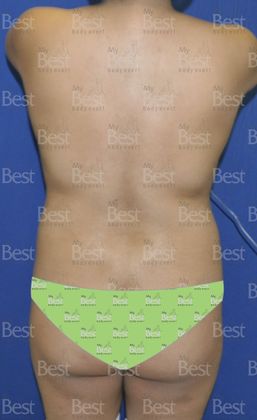 Mommy Makeover -Abdomen, Breast, Lipo, BBL-: Tummy Tuck, Breast Lift and Liposculpture with fat transfer to the Butt - Before Mommy Makeover Posterior view