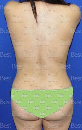 Mommy Makeover -Abdomen, Breast, Lipo, BBL-: Tummy Tuck, Breast Lift and Liposculpture with fat transfer to the Butt - After Mommy Makeover Posterior view