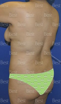 Mommy Makeover -Abdomen, Breast, Lipo, BBL-: Tummy Tuck, Breast Lift and Liposculpture with fat transfer to the Butt - Before Mommy Makeover Posterior oblique view