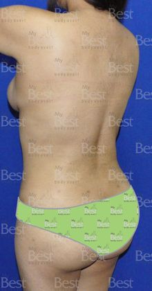 Mommy Makeover -Abdomen, Breast, Lipo, BBL-: Tummy Tuck, Breast Lift and Liposculpture with fat transfer to the Butt - After Mommy Makeover Posterior oblique view