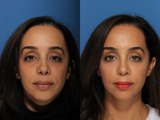 Revision Rhinoplasty : Case 1