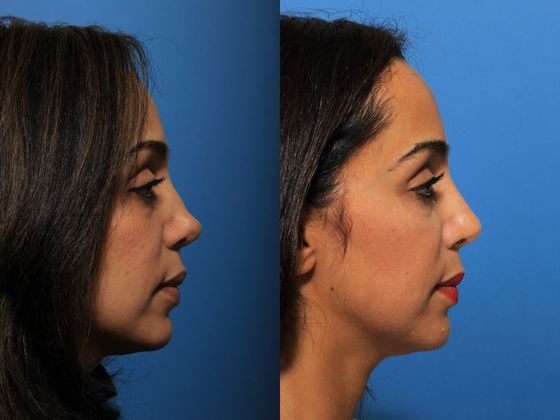 Revision Rhinoplasty : Case 1
