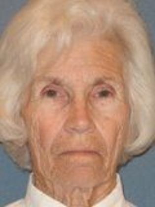 Ptosis Repair: Case 7 - Before Surgery