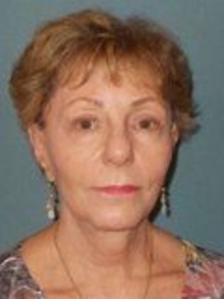 Ptosis Repair: Case 11 - After Surgery